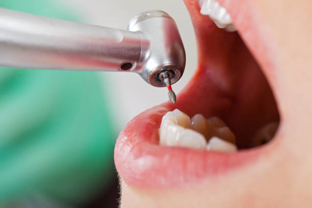 Best Emergency Root Canal Treatment in Grove City, FL
